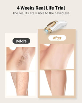 IPL Hair Removal Laser with 9 Gears & Ice-Cooling for Men & Women